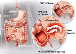 You are currently viewing Maladie de Crohn: le secret pour guérir