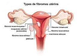 You are currently viewing Fibrome utérin cause et signes