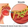 Sinusite causes et symptômes