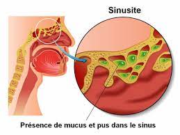 Sinusite causes et symptômes