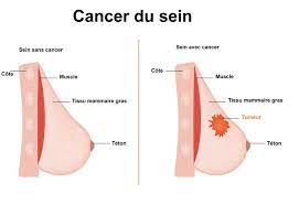 Lire la suite à propos de l’article Cancer du sein
