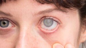 Lire la suite à propos de l’article La cataracte : quels sont les traitements