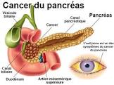 Lire la suite à propos de l’article Cancer du Pancréas