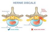 Lire la suite à propos de l’article Hernie discale diagnostique