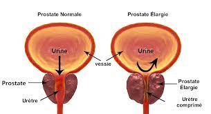 Produit contre l’adénome de la prostate