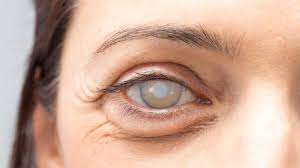 Cataracte cause signe et traitement