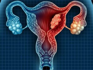 cancer du col de l'utérus