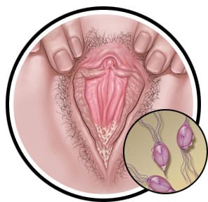 Lire la suite à propos de l’article La vaginite à trichomonas qu’est-ce que c’est ?