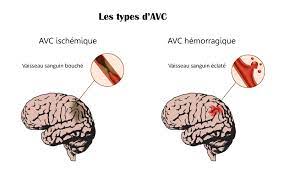You are currently viewing Accident vasculaire cérébral : reconnaître les signes et agir rapidement