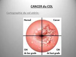 Lire la suite à propos de l’article Facteur de risque et traitement du cancer du col de l’utérus