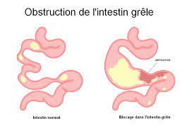Lire la suite à propos de l’article Comment s’en débarrasser de l’occlusion intestinale ?