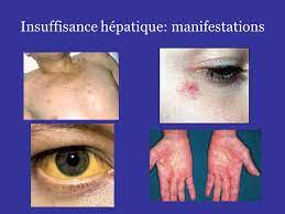 You are currently viewing Insuffisance hépatique: Causes, Symptômes et Options de Traitement