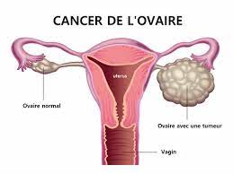 You are currently viewing Le cancer des ovaires : une bataille contre l’ombre silencieuse