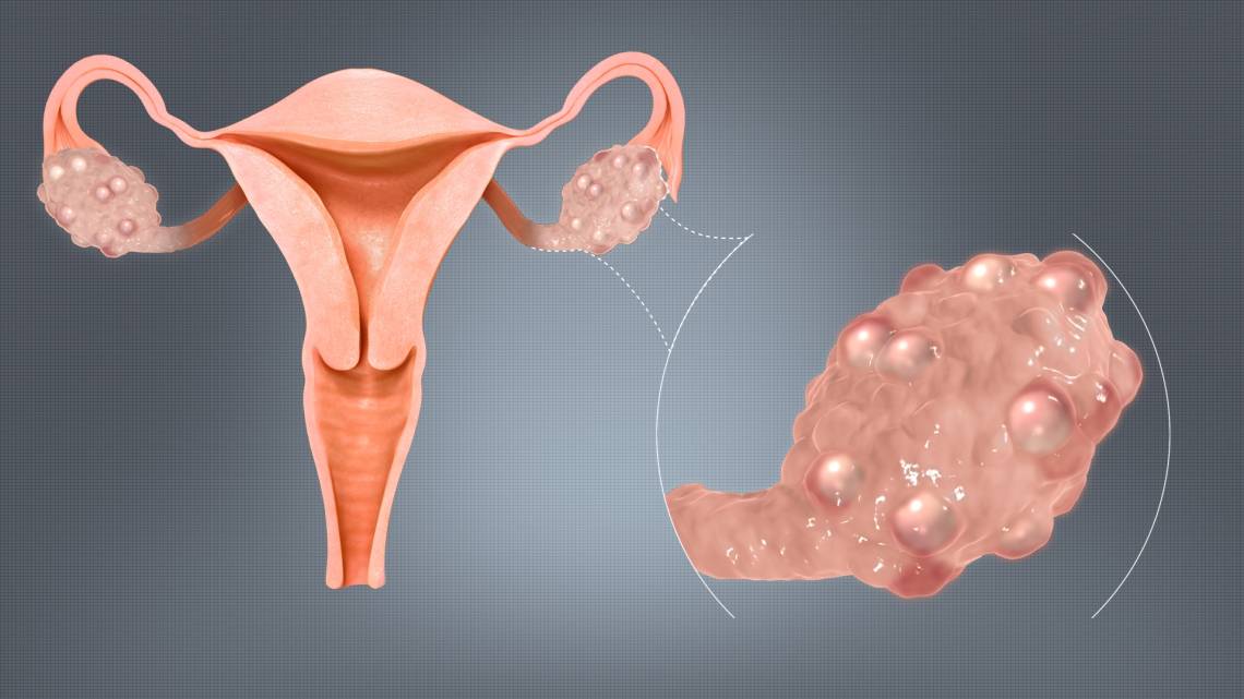 Lire la suite à propos de l’article Kystes ovariens : causes localisation et traitements