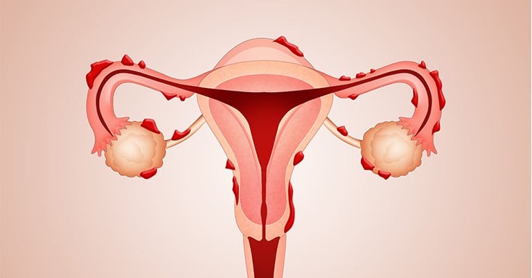 Lire la suite à propos de l’article L’endométriose : qu’est-ce que c’est ?
