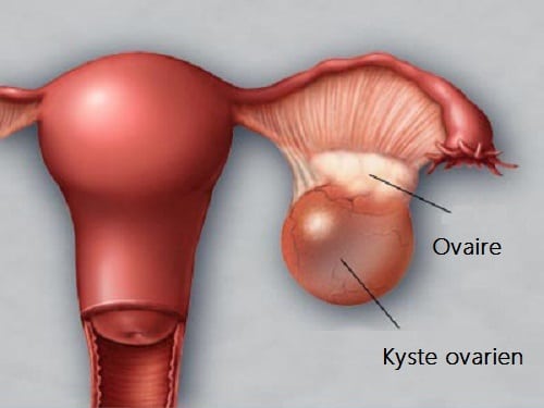 Lire la suite à propos de l’article Kystes ovariens : comment se forment-ils