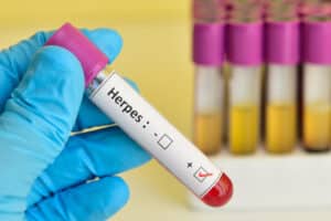 Lire la suite à propos de l’article L’herpès génital causes et traitements