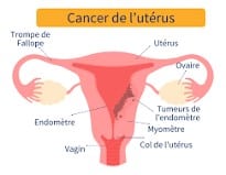 Lire la suite à propos de l’article Cancer de l’utérus : Dépistage, symptômes et traitement