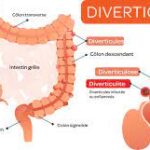 Diverticulite : Causes, symptômes, diagnostic et prise en charge