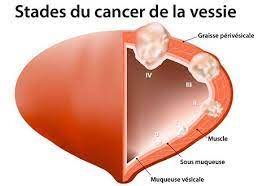 Lire la suite à propos de l’article Cancer de la vessie : Causes, symptômes, diagnostic et traitements