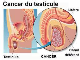 Lire la suite à propos de l’article Cancer des testicules : Détection précoce et survie accrue