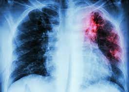 You are currently viewing Comprendre la Fibrose Pulmonaire: Symptômes, Causes et Traitements