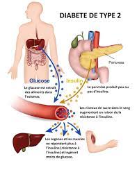 You are currently viewing Diabète de type 2 : Causes, symptômes et gestion de cette maladie chronique