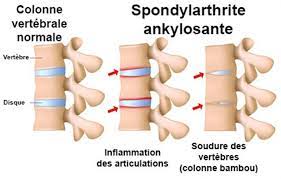 You are currently viewing Spondylarthrite ankylosante Symptômes et diagnostic