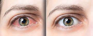 You are currently viewing Glaucome: Comprendre cette Maladie Silencieuse des Yeux
