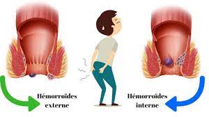 You are currently viewing Hémorroïde Externe : Causes, Symptômes et Options de Traitement