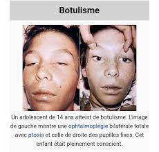 You are currently viewing Botulisme : une maladie rare mais grave causée par la bactérie Clostridium botulinum