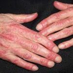 Dermatomyosite : Une maladie auto-immune rare affectant la peau et les muscles