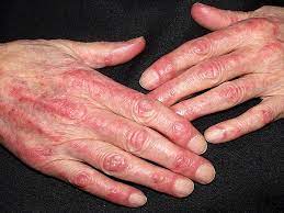 Lire la suite à propos de l’article Dermatomyosite : Une maladie auto-immune rare affectant la peau et les muscles