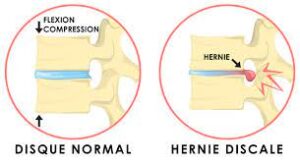 Lire la suite à propos de l’article Hernie discale : comprendre cette affection douloureuse de la colonne vertébrale