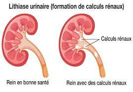 You are currently viewing Calculs rénaux : une affection douloureuse affectant les voies urinaires
