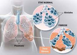 You are currently viewing Fibrose : compréhension d’une condition complexe et progressive