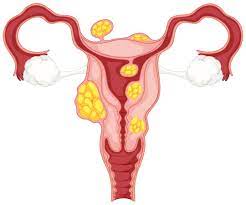 Lire la suite à propos de l’article Fibrome ovarien : comprendre cette tumeur bénigne de l’ovaire