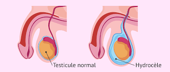 You are currently viewing Hydrocèle testiculaire : causes, symptômes et traitements