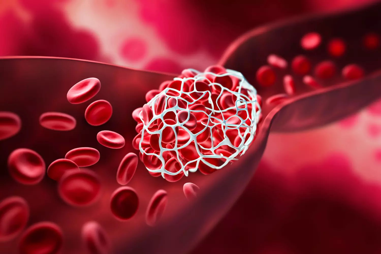 Lire la suite à propos de l’article Formation de Caillots de Sang : Comprendre les Causes, les Types et les Traitements pour Préserver Votre Santé Vasculaire