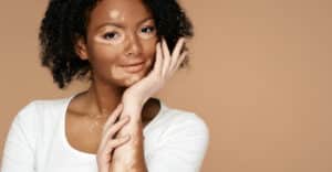 Lire la suite à propos de l’article Le Vitiligo : Comprendre en Profondeur cette Condition Cutanée et Agir pour la Sensibilisation