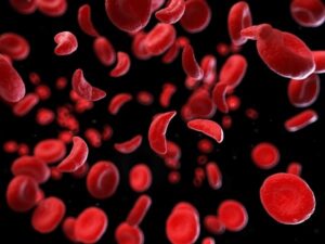 Lire la suite à propos de l’article Tout Savoir sur l’Anémie Falciforme : Comprendre une Maladie Génétique Complexe