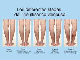 You are currently viewing Comprendre l’Insuffisance Veineuse : Causes, Symptômes et Options de Gestion