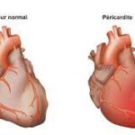 Péricardite : Comprendre l’Inflammation du Péricarde