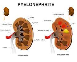 You are currently viewing Pyélonéphrite : Comprendre l’Infection Rénales Sévère