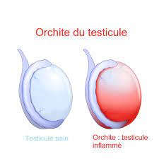 You are currently viewing Orchite : Comprendre l’Inflammation douloureuse des Testicules