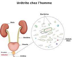 Lire la suite à propos de l’article Comprendre l’Infection de l’Urètre : Causes, Symptômes et Traitements