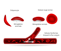 You are currently viewing Drépanocytose : Comprendre une Maladie Génétique Héréditaire et ses Implications