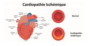 Lire la suite à propos de l’article Comprendre la Cardiopathie Ischémique : Causes, Symptômes et Traitements