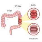 Colite ulcéreuse : Comprendre les causes, les symptômes et les traitements