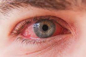 You are currently viewing Conjonctivite : Comprendre cette infection oculaire courante et comment la traiter
